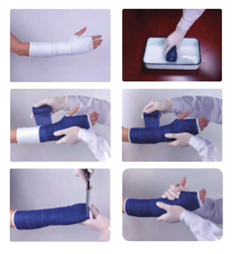 Orthopedic Casting Tape အသုံးပြုခြင်းအတွက် အဆင့်များ